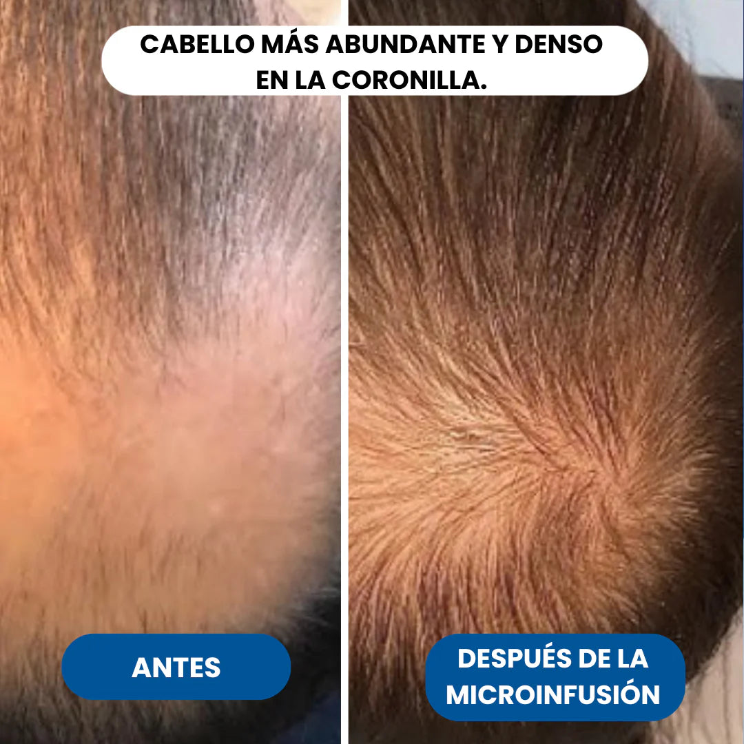 El sistema de microinfusión para el crecimiento del cabello